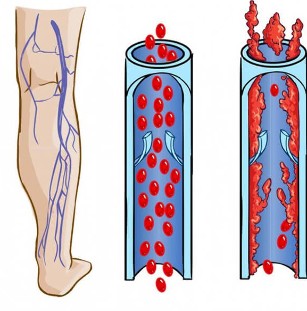 Varisli damarlarda normal bir damar ve damar nasıl görünür 
