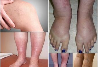 Bacaklardaki varisli damarların tezahürlerinin fotoğrafları
