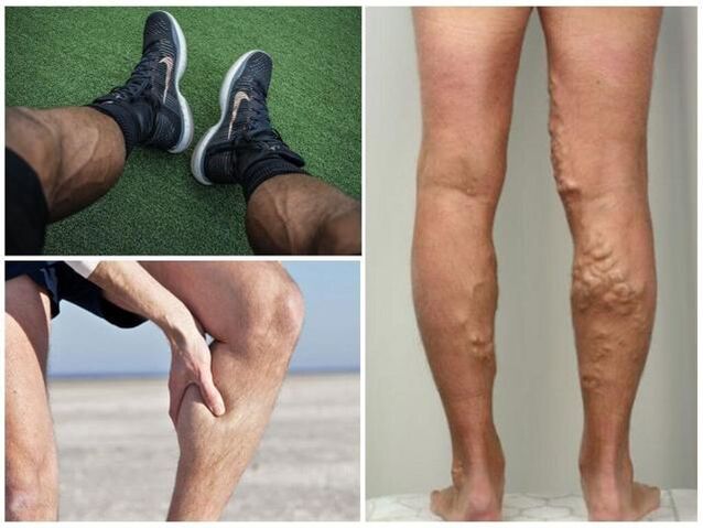 erkeklerin bacaklarında varisli damarlar nasıl görünüyor