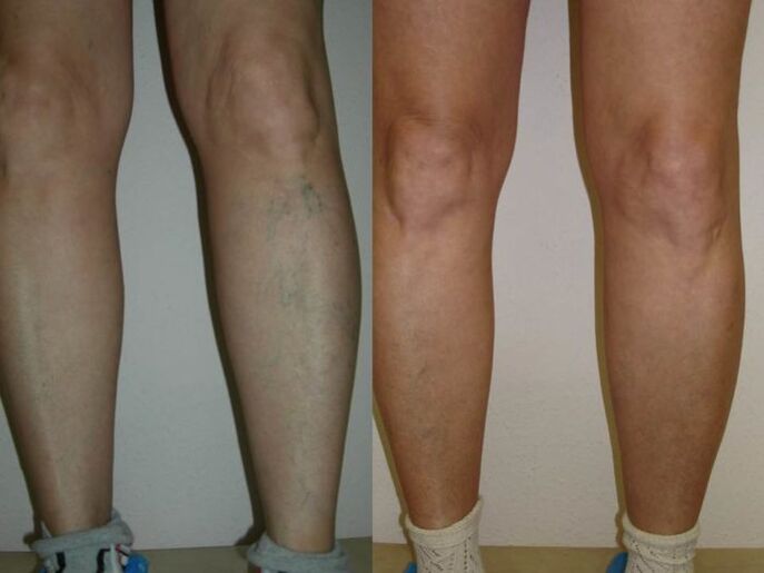 varis lazer tedavisi öncesi ve sonrası bacaklar