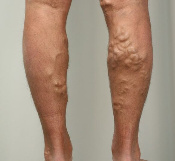 Bacaklarda varisli damarlar