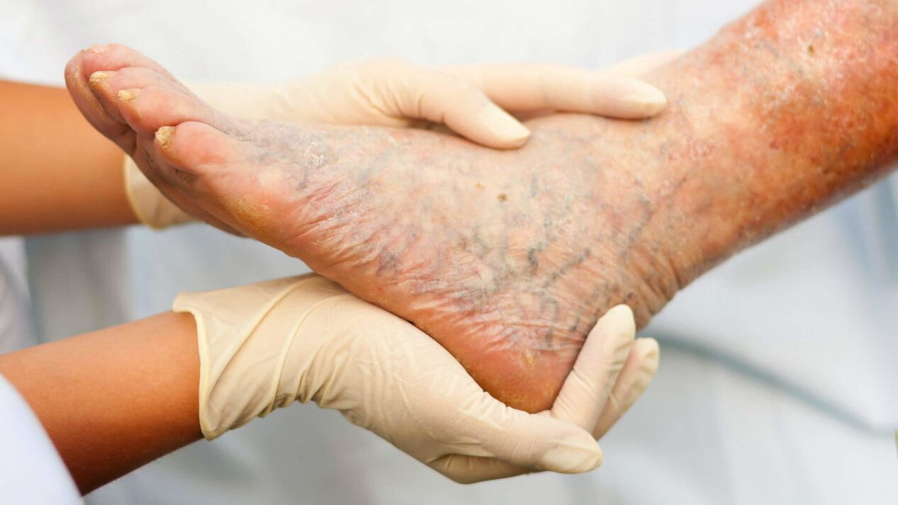 Flebolog, bacaklardaki varislerin tedavisi ile ilgilenir. 