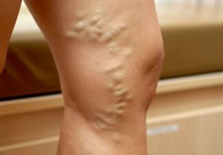 Bir kadının bacaklarında varisli damarlar